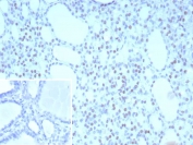 IHC staining of FFPE human thyroid tissue with NKX2.1 antibody (clone NX2.1/9031). Inset: PBS used in place of primary Ab (secondary Ab negative control). HIER: boil tissue sections in pH 9 10mM Tris with 1mM EDTA for 20 min and allow to cool before testing.