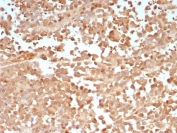 IHC staining of FFPE human melanoma tissue with PRAME antibody (clone PRAME/9188). HIER: boil tissue sections in pH 9 10mM Tris with 1mM EDTA for 20 min and allow to cool before testing.