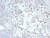 IHC staining of FFPE human melanoma tissue with Opa-interacting protein 4 antibody (clone PRAME/9189). HIER: boil tissue sections in pH 9 10mM Tris with 1mM EDTA for 20 min and allow to cool before testing.