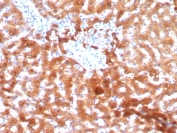 IHC staining of FFPE human hepatocellular carcinoma tissue with AKR1C1 antibody (clone AKR1C1/9069). HIER: boil tissue sections in pH 9 10mM Tris with 1mM EDTA for 20 min and allow to cool before testing.