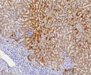 IHC staining of FFPE human hepatocellular carcinoma tissue with AKR1C1 antibody (clone AKR1C1/9311). HIER: boil tissue sections in pH 9 10mM Tris with 1mM EDTA for 20 min and allow to cool before testing.