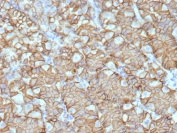 IHC staining of FFPE human renal cell carcinoma tissue with Carbonic Anhydrase IX antibody (clone CA9/9621R). HIER: boil tissue sections in pH 9 10mM Tris with 1mM EDTA for 20 min and allow to cool before testing.