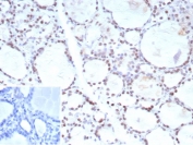 IHC staining of FFPE human prostate carcinoma tissue with FOXP1 antibody (clone FOXP1/9381R). Inset: PBS used in place of primary Ab (secondary Ab negative control). HIER: boil tissue sections in pH 9 10mM Tris with 1mM EDTA for 20 min and allow to cool before testing.