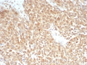 IHC staining of FFPE human triple negative breast cancer tissue with recombinant xCT antibody (clone SLC7A11/9136R). HIER: boil tissue sections in pH 9 10mM Tris with 1mM EDTA for 20 min and allow to cool before testing.