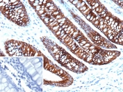IHC staining of FFPE human colon tissue with Cadherin 17 antibody (clone CDH17/2612). Inset: PBS used in place of primary Ab (secondary Ab negative control). HIER: boil tissue sections in pH 9 10mM Tris with 1mM EDTA for 20 min and allow to cool before testing.