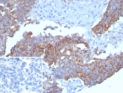 IHC staining of FFPE human ovarian carcinoma tissue with recombinant MSLN antibody (clone MSLN/8331R). Inset: PBS used in place of primary Ab (secondary Ab negative control). HIER: boil tissue sections in pH 9 10mM Tris with 1mM EDTA for 20 min and allow to cool before testing.
