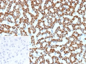 IHC staining of FFPE human hepatocellular carcinoma tissue with CPS1 antibody (clone CPS1/9857). Inset: PBS used in place of primary Ab (secondary Ab negative control). HIER: boil tissue sections in pH 9 10mM Tris with 1mM EDTA for 20 min and allow to cool before testing.