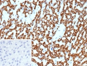 IHC staining of FFPE human hepatocellular carcinoma tissue with CPS1 antibody (clone CPS1/9859). Inset: PBS used in place of primary Ab (secondary Ab negative control). HIER: boil tissue sections in pH 9 10mM Tris with 1mM EDTA for 20 min and allow to cool before testing.