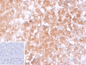 IHC staining of FFPE human hepatocellular carcinoma tissue with CYP2C9 antibody (clone CYP2C9/13121). Inset: PBS used in place of primary Ab (secondary Ab negative control). HIER: boil tissue sections in pH 9 10mM Tris with 1mM EDTA for 20 min and allow to cool before testing.