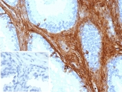 IHC staining of FFPE human prostate carcinoma tissue with Decorin antibody (clone DCN/3521). Inset: PBS used in place of primary Ab (secondary Ab negative control). HIER: boil tissue sections in pH 9 10mM Tris with 1mM EDTA for 20 min and allow to cool before testing.