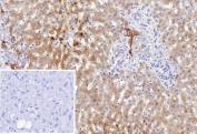 IHC staining of FFPE human hepatocellular carcinoma tissue with Dihydrodiol dehydrogenase 1 antibody (clone AKR1C1/9318). Inset: PBS used in place of primary Ab (secondary Ab negative control). HIER: boil tissue sections in pH 9 10mM Tris with 1mM EDTA for 20 min and allow to cool before testing.