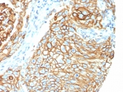 IHC staining of FFPE human lung carcinoma tissue with Tissue Factor antibody (clone CD142/9195). HIER: boil tissue sections in pH 9 10mM Tris with 1mM EDTA for 20 min and allow to cool before testing.
