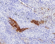 IHC staining of FFPE human lung tissue with Tissue Factor antibody (clone CD142/9196). HIER: boil tissue sections in pH 9 10mM Tris with 1mM EDTA for 20 min and allow to cool before testing.