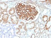 IHC staining of FFPE human kidney tissue with PLA2R1 antibody (clone PLA2R1/4893). Inset: PBS used in place of primary Ab (secondary Ab negative control). HIER: boil tissue sections in pH 9 10mM Tris with 1mM EDTA for 20 min and allow to cool before testing.
