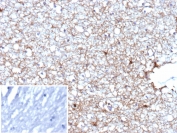 IHC staining of FFPE human brain tissue with Glial fibrillary acidic protein antibody (clone GFAP/9426). Inset: PBS used in place of primary Ab (secondary Ab negative control). HIER: boil tissue sections in pH 9 10mM Tris with 1mM EDTA for 20 min and allow to cool before testing.