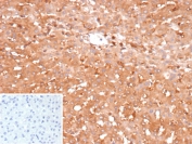 IHC staining of FFPE human hepatocellular carcinoma tissue with Glucose-6-phosphate isomerase antibody (clone GPI/2439). Inset: PBS used in place of primary Ab (secondary Ab negative control). HIER: boil tissue sections in pH 9 10mM Tris with 1mM EDTA for 20 min and allow to cool before testing.