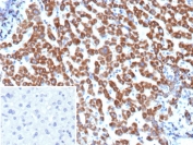 IHC staining of FFPE human hepatocellular carcinoma tissue with Angiopoietin 1 antibody (clone ANGPT1/3651). Inset: PBS used in place of primary Ab (secondary Ab negative control). HIER: boil tissue sections in pH 9 10mM Tris with 1mM EDTA for 20 min and allow to cool before testing.