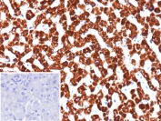 IHC staining of FFPE human hepatocellular carcinoma tissue with Phosphohistidine phosphatase 1 antibody (clone PHPT1/12054). Inset: PBS used in place of primary Ab (secondary Ab negative control). HIER: boil tissue sections in pH 9 10mM Tris with 1mM EDTA for 20 min and allow to cool before testing.