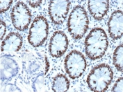 IHC staining of FFPE human colon tissue with recombinant GTBP antibody (clone MSH6/13194R). Inset: PBS used in place of primary Ab (secondary Ab negative control). HIER: boil tissue sections in pH 9 10mM Tris with 1mM EDTA for 20 min and allow to cool before testing.
