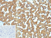 IHC staining of FFPE human hepatocellular carcinoma tissue with 17-beta-HSD 13 antibody (clone HSD17B13/13104). Inset: PBS used in place of primary Ab (secondary Ab negative control). HIER: boil tissue sections in pH 9 10mM Tris with 1mM EDTA for 20 min and allow to cool before testing.