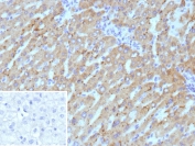IHC staining of FFPE human hepatocellular carcinoma tissue with Hydroxysteroid 17-beta dehydrogenase 13 antibody (clone HSD17B13/13108). Inset: PBS used in place of primary Ab (secondary Ab negative control). HIER: boil tissue sections in pH 9 10mM Tris with 1mM EDTA for 20 min and allow to cool before testing.