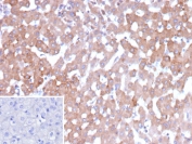 IHC staining of FFPE human hepatocellular carcinoma tissue with 17-beta-hydroxysteroid dehydrogenase 13 antibody (clone HSD17B13/13109). Inset: PBS used in place of primary Ab (secondary Ab negative control). HIER: boil tissue sections in pH 9 10mM Tris with 1mM EDTA for 20 min and allow to cool before testing.