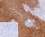 IHC staining of FFPE human hepatocellular carcinoma tissue with Liver Arginase antibody (clone ARG1/9447). Inset: PBS used in place of primary Ab (secondary Ab negative control). HIER: boil tissue sections in pH 9 10mM Tris with 1mM EDTA for 20 min and allow to cool before testing.