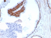 IHC staining of FFPE human prostate tissue with CK13 antibody (clone KRT13/8577R). Inset: PBS used in place of primary Ab (secondary Ab negative control). HIER: boil tissue sections in pH 9 10mM Tris with 1mM EDTA for 20 min and allow to cool before testing.