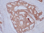 IHC staining of FFPE human colon adenocarcinoma with EpCAM antibody (clone Ber-EP4). HIER: boil tissue sections in pH 9 10mM Tris with 1mM EDTA for 10-20 min and allow to cool before testing.
