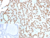 IHC staining of FFPE human thyroid tissue with Cyclin D1 antibody (clone CCND1/12039). Inset: PBS used in place of primary Ab (secondary Ab negative control). HIER: boil tissue sections in pH 9 10mM Tris with 1mM EDTA for 20 min and allow to cool before testing.