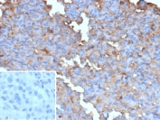 IHC staining of FFPE human melanoma tissue with recombinant BRAF V600E antibody (clone BRAF-V600E/13276R). Inset: PBS used in place of primary Ab (secondary Ab negative control). HIER: boil tissue sections in pH 9 10mM Tris with 1mM EDTA for 20 min and allow to cool before testing.