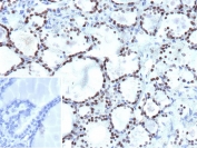 IHC staining of FFPE human thyroid tissue with NKX2.1 antibody (clone NX2.1/9033). Inset: PBS used in place of primary Ab (secondary Ab negative control). HIER: boil tissue sections in pH 9 10mM Tris with 1mM EDTA for 20 min and allow to cool before testing.