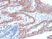 IHC staining of FFPE human ovarian carcinoma tissue with recombinant Tumor Protein 53 antibody (clone TP53/8183R). Inset: PBS used in place of primary Ab (secondary Ab negative control). HIER: boil tissue sections in pH 9 10mM Tris with 1mM EDTA for 20 min and allow to cool before testing.