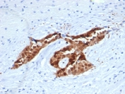 IHC staining of FFPE human mesothelioma tissue with recombinant Calretinin antibody (clone CALB2/4688R). Inset: PBS used in place of primary Ab (secondary Ab negative control). HIER: boil tissue sections in pH 9 10mM Tris with 1mM EDTA for 20 min and allow to cool before testing.