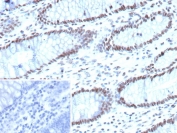 IHC staining of FFPE human colon tissue with ARID1A antibody (clone ARID1A/7736). Inset: PBS used in place of primary Ab (secondary Ab negative control). HIER: boil tissue sections in pH 9 10mM Tris with 1mM EDTA for 20 min and allow to cool before testing.