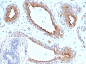 IHC staining of FFPE human breast carcinoma tissue with BAP1 antibody (clone BAP1/13501R). Inset: PBS used in place of primary Ab (secondary Ab negative control). HIER: boil tissue sections in pH 9 10mM Tris with 1mM EDTA for 20 min and allow to cool before testing.