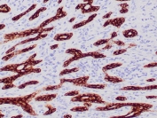 IHC staining of FFPE human breast carcinoma tissue with Cytokeratin CAM5.2 antibody (clone CAM5.2). HIER: boil tissue sections in pH 9 10mM Tris with 1mM EDTA for 20 min and allow to cool before testing.