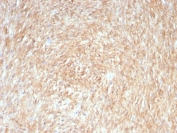 IHC testing of FFPE human gastrointestinal stromal tumor (GIST) with ANO1 antibody (clone rDG1/8750). Required HIER: boil tissue sections in pH 9 10mM Tris with 1mM EDTA for 10-20 min followed by cooling at RT for 20 min.