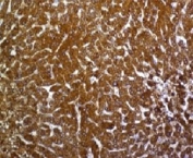 IHC testing of FFPE human hepatocellular carcinoma with Glypican-3 antibody (clone SGPN3-1).