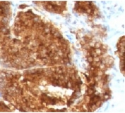 IHC staining of human prostate carcinoma with TAG-72 antibody (clone TAGP-4).