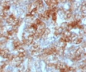 IHC testing of FFPE human renal cell carcinoma and Cadherin 16 antibody (clone KSCP2). Staining of formalin-fixed tissues requires boiling tissue sections in 10mM Tris with 1mM EDTA, pH 9.0, for 10-20 min followed by cooling at RT for 20 min.