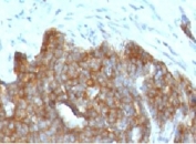 IHC testing of FFPE ovarian carcinoma with TFF1 antibody (clone BCEIP1).