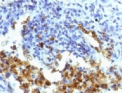 IHC testing of FFPE human lung adenocarcinoma with Napsin A antibody (clone NPSNA-1). FFPE testing requires sections to be boiled in pH 9 10mM Tris with 1mM EDTA for 10-20 minutes, followed by cooling at RT for 20 minutes, prior to staining.