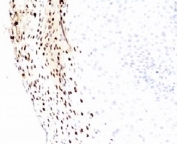 IHC testing of FFPE human cervix with HPV-16 L1 antibody (clone MCAPL1). FFPE testing requires sections to be boiled in pH 9 10mM Tris with 1mM EDTA for 10-20 minutes, followed by cooling at RT for 20 minutes, prior to staining.