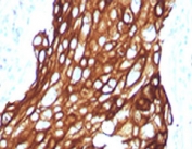 IHC testing of FFPE human lung carcinoma with recombinant Acidic Cytokeratin antibody (clone RMAK1-1). Required HIER: steam sections in pH 9 10mM Tris with 1mM EDTA for 10-20 min.