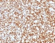 IHC testing of FFPE Ewings sarcoma with recombinant NKX2.2 antibody (clone RMNK2-1). HIER: steam sections in pH 9 10mM Tris with 1mM EDTA for 10-20 min.