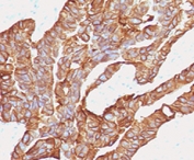 IHC testing of human colorectal carcinoma with anti-EpCAM antibody (clone EPM17-2). Staining of FFPE tissue requires boiling sections in pH 9 10mM Tris with 1mM EDTA for 10-20 min followed by cooling at RT for 20 min.