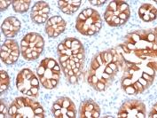 IHC testing of FFPE human colon carcinoma and recombinant EpCAM antibody (clone EGP40/1555R). HIER: steam sections in pH9 EDTA for 10-20 min.