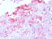 IHC testing FFPE human melanoma with recombinant Melan-A antibody (clone MLANA/1761R). HIER: steam sections in pH 9 10mM Tris with 1mM EDTA for 10-20 min.