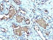 IHC testing of FFPE human angiosarcoma with recombinant Glycophorin A antibody (clone GYPA/1725R). Required HIER: boil tissue sections in pH 9 10mM Tris with 1mM EDTA for 10-20 min.